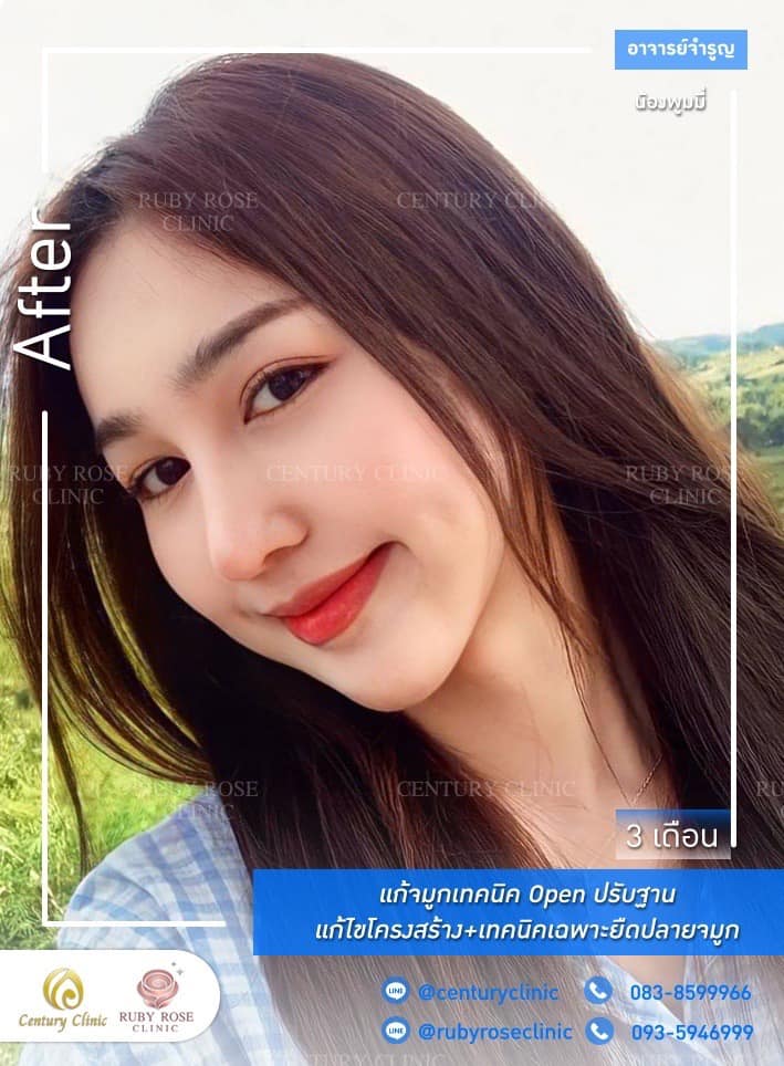Century-รีวิว-แก้จมูก #439