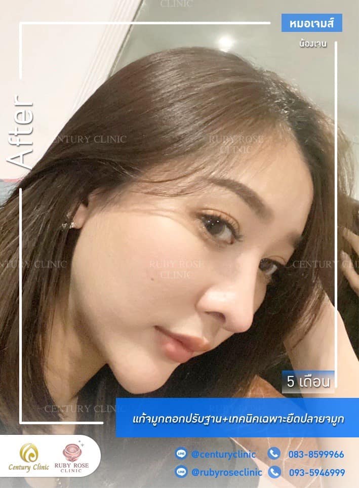 รีวิว แก้จมูก #440 , Century Clinic Thailand Century-รีวิว-แก้จมูก #440