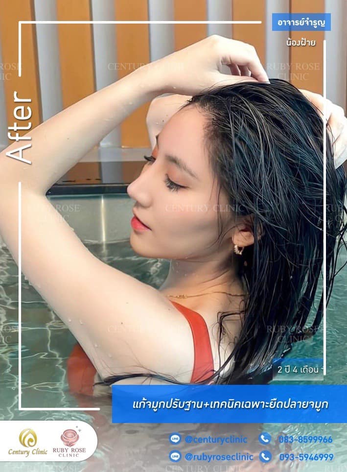 Century-รีวิว-แก้จมูก #444