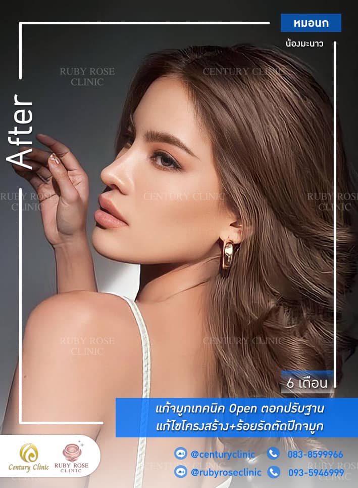 Century-รีวิว-แก้จมูก #446