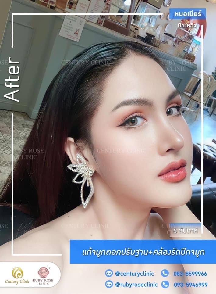 รีวิว แก้จมูก #448 , Century Clinic Thailand Century-รีวิว-แก้จมูก #448