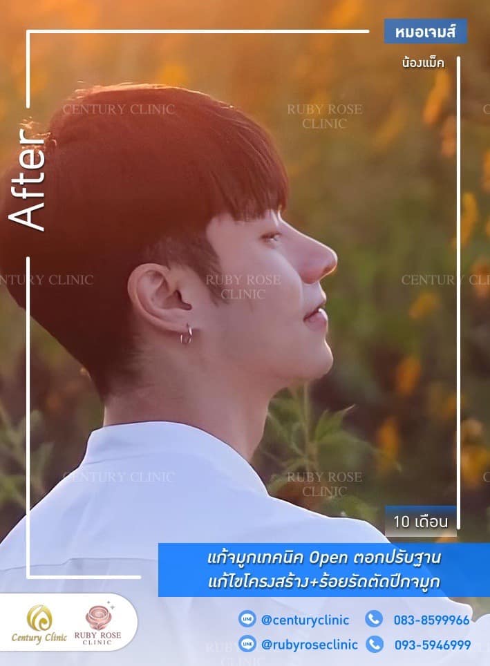 Century-รีวิว-แก้จมูก #450