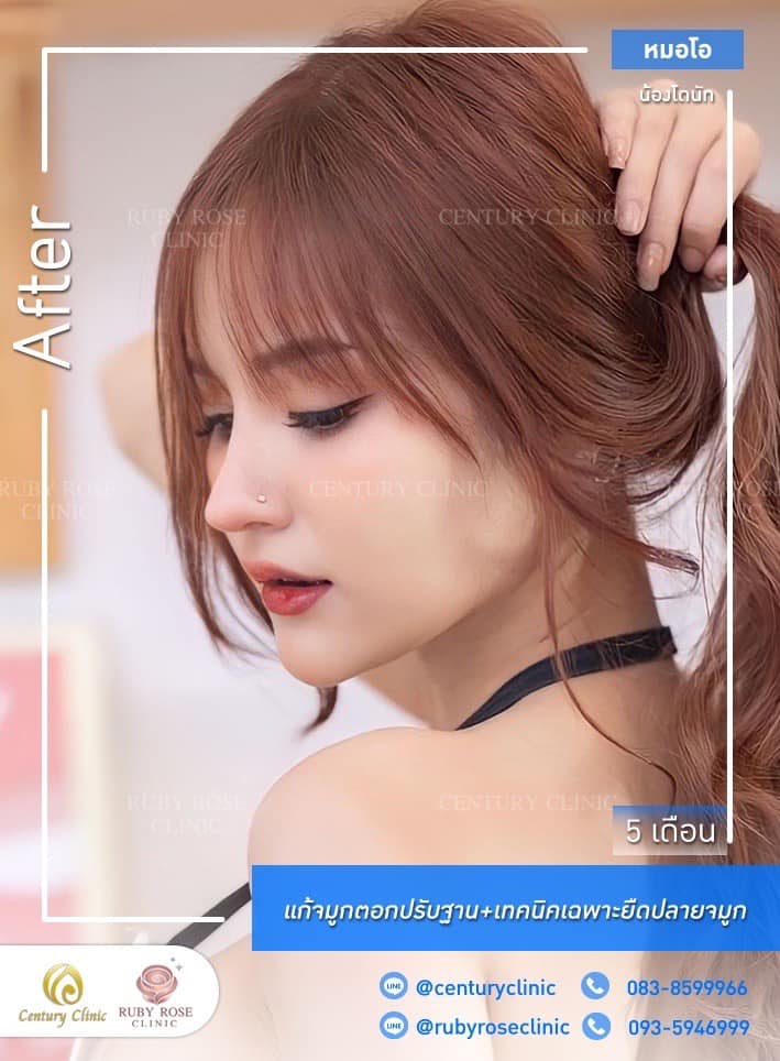 Century-รีวิว-แก้จมูก #452