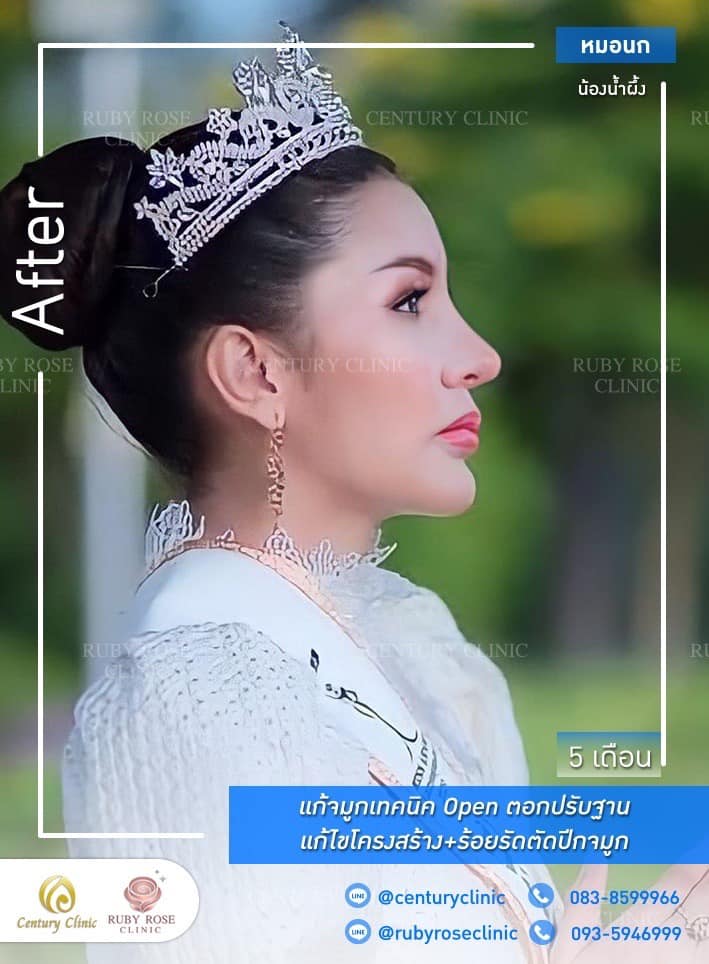 รีวิว แก้จมูก #457 , Century Clinic Thailand Century-รีวิว-แก้จมูก #457
