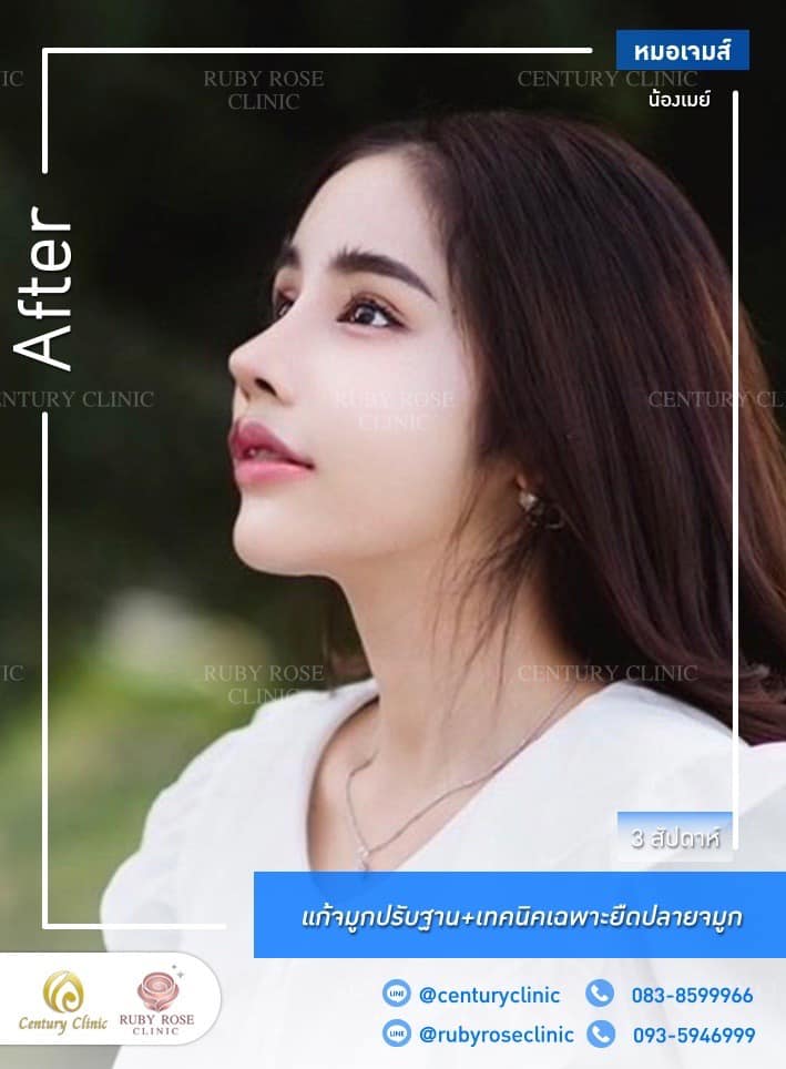Century-รีวิว-แก้จมูก #461