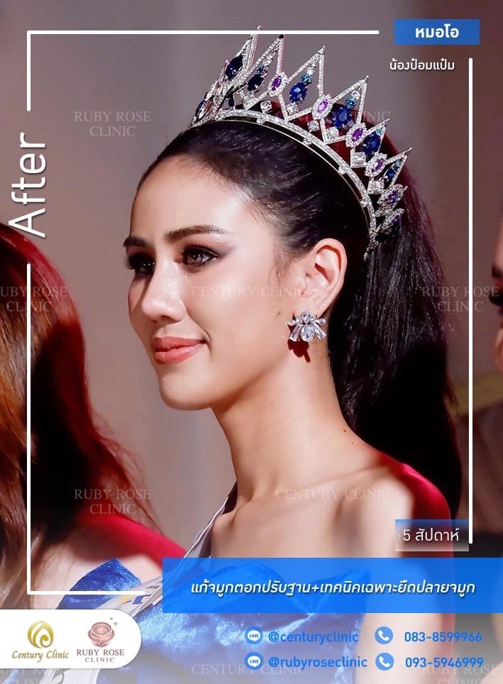 Century-รีวิว-แก้จมูก #463