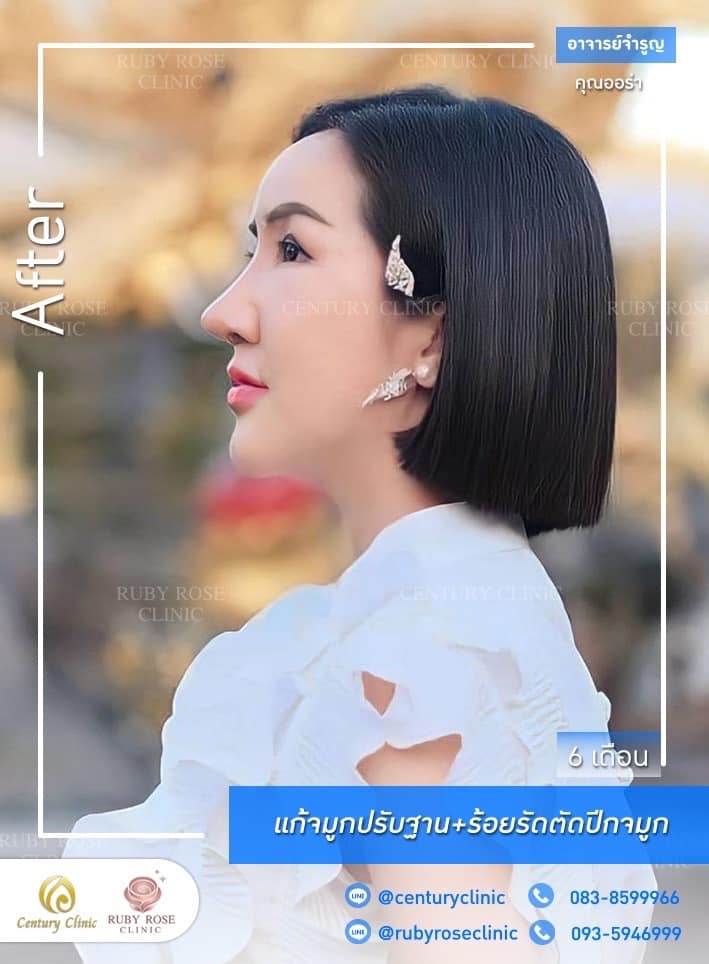 รีวิว แก้จมูก #465 , Century Clinic Thailand Century-รีวิว-แก้จมูก #465