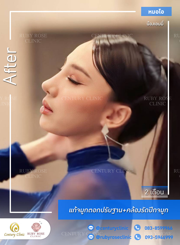 Century-รีวิว-แก้จมูก #468
