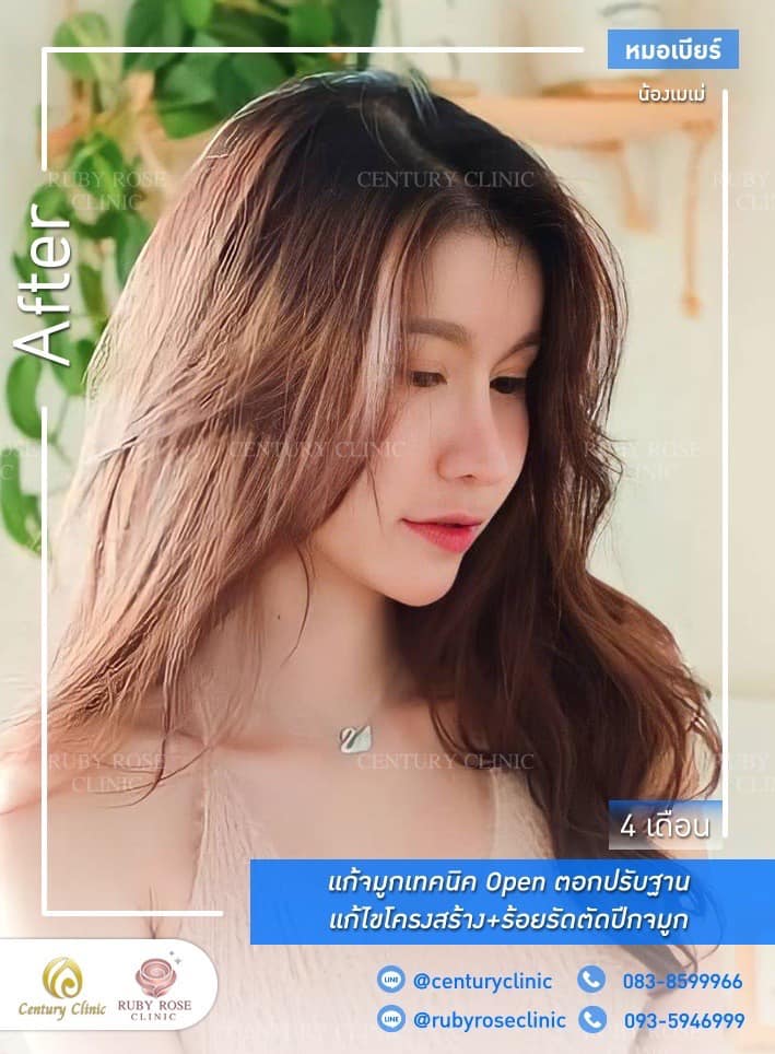 รีวิว แก้จมูก #469 , Century Clinic Thailand Century-รีวิว-แก้จมูก #469