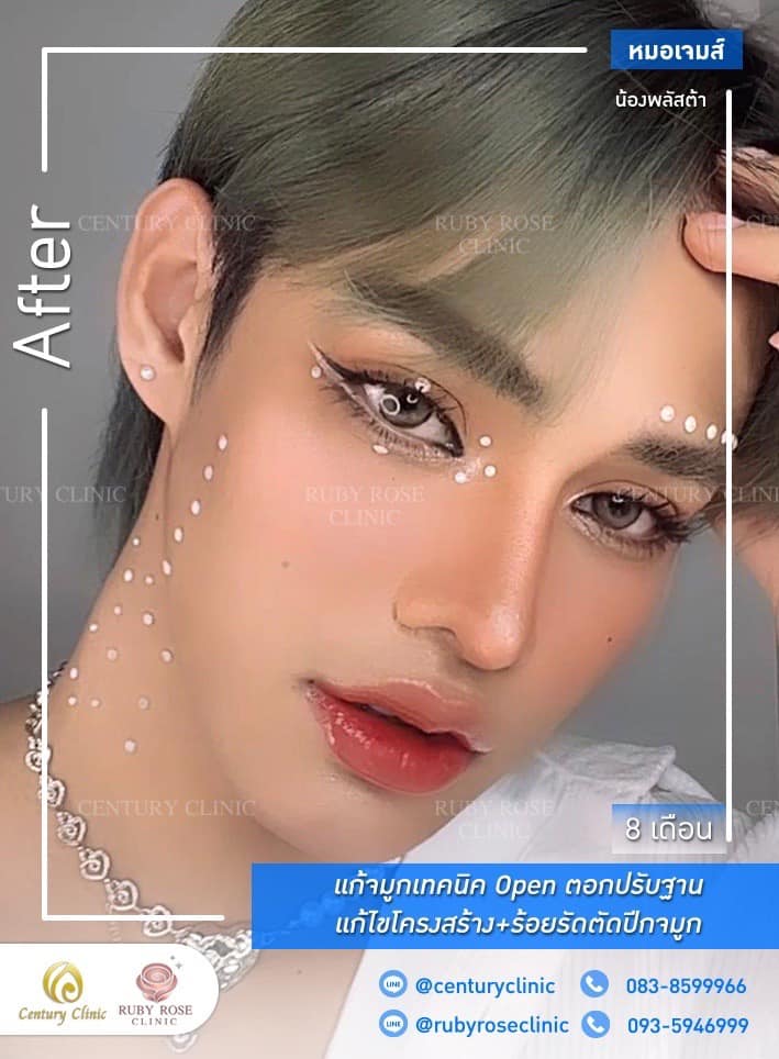 Century-รีวิว-แก้จมูก #470