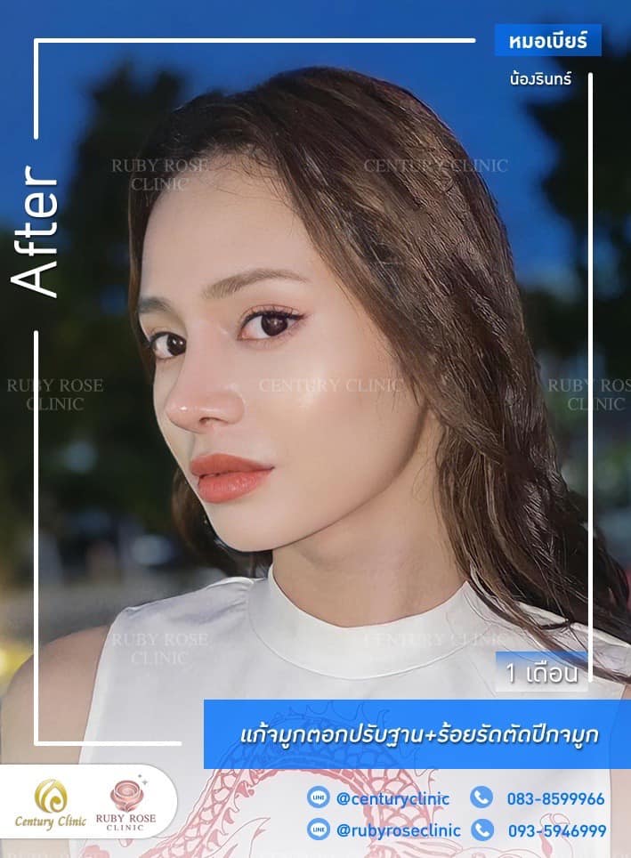 Century-รีวิว-แก้จมูก #473
