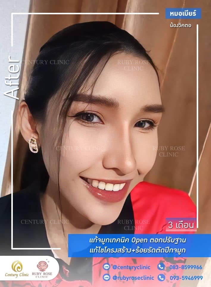 Century-รีวิว-แก้จมูก #478
