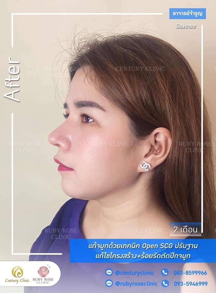 Century-รีวิว-แก้จมูก #484
