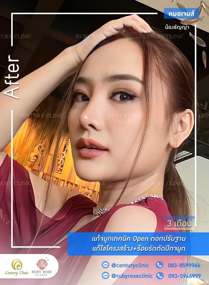 รีวิว แก้จมูก #485 , Century Clinic Thailand Century Clinic Thailand
