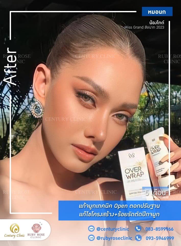 Century-รีวิว-แก้จมูก #486