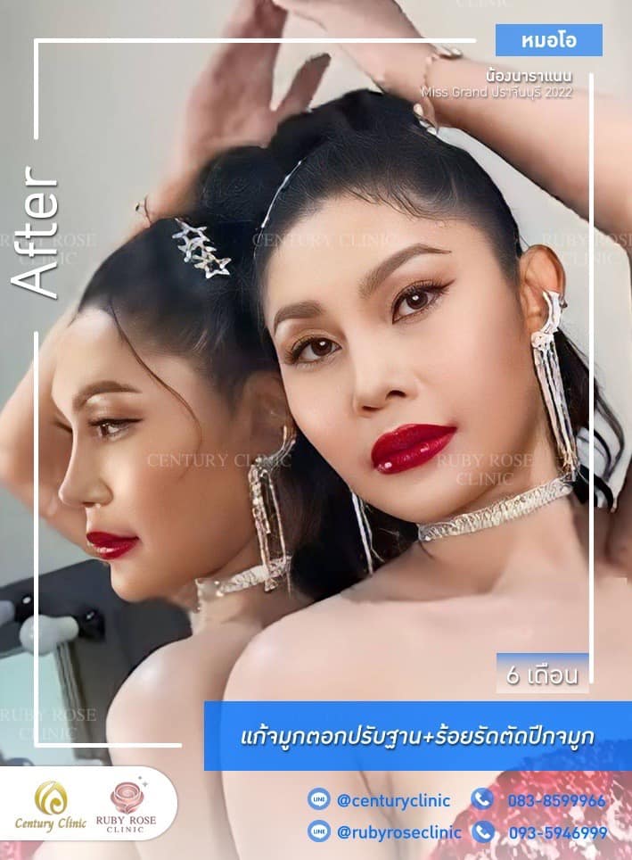 Century-รีวิว-แก้จมูก #487