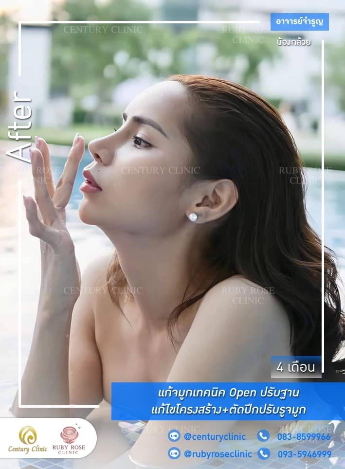 Century-รีวิว-แก้จมูก #490