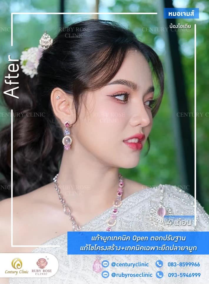 Century-รีวิว-แก้จมูก #491