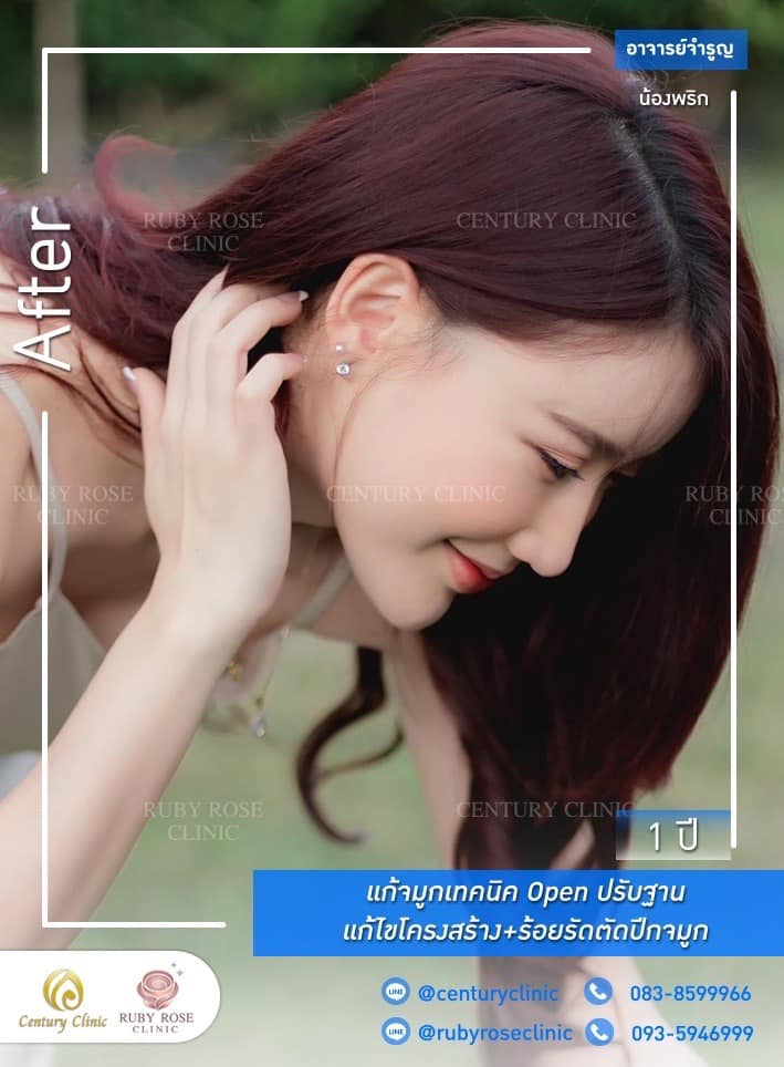 Century-รีวิว-แก้จมูก #493
