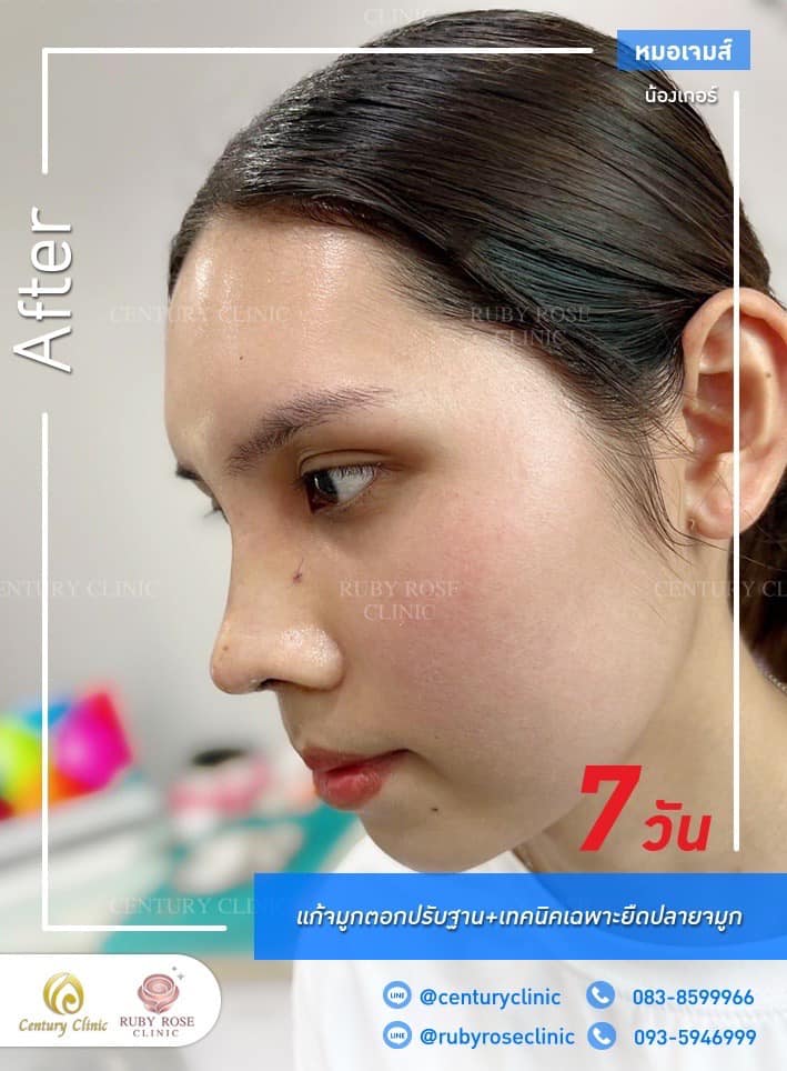 Century-รีวิว-แก้จมูก #499