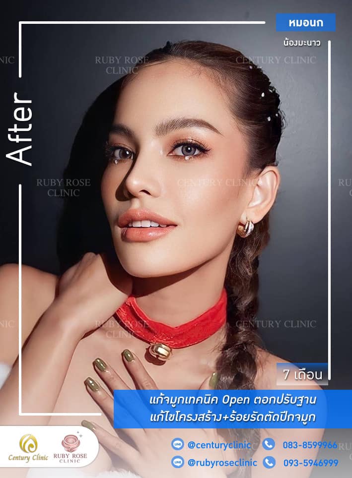 Century-รีวิว-แก้จมูก #500