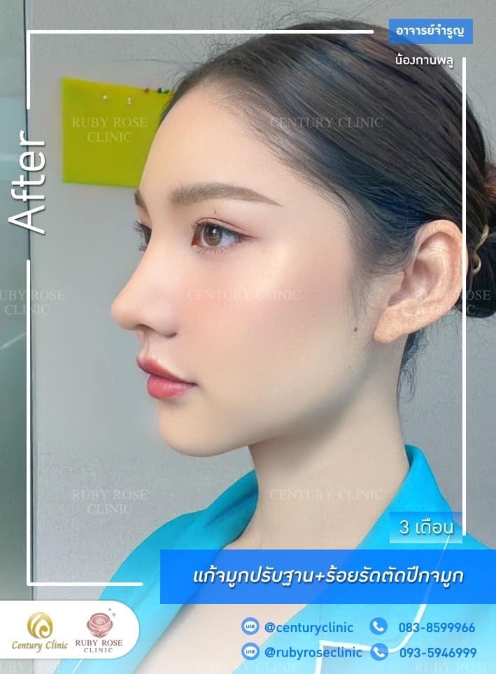 Century-รีวิว-แก้จมูก #503