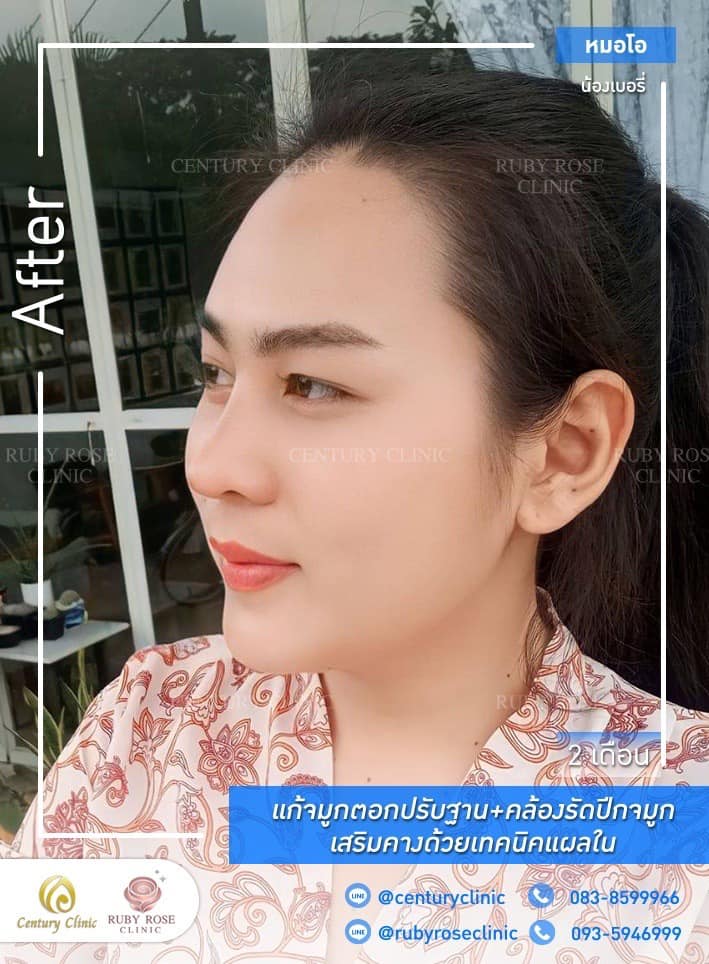 รีวิว แก้จมูก #506 , Century Clinic Thailand Century-รีวิว-แก้จมูก #506