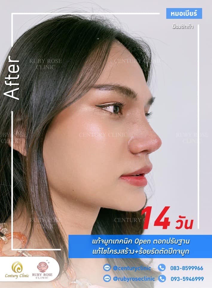 Century-รีวิว-แก้จมูก #507