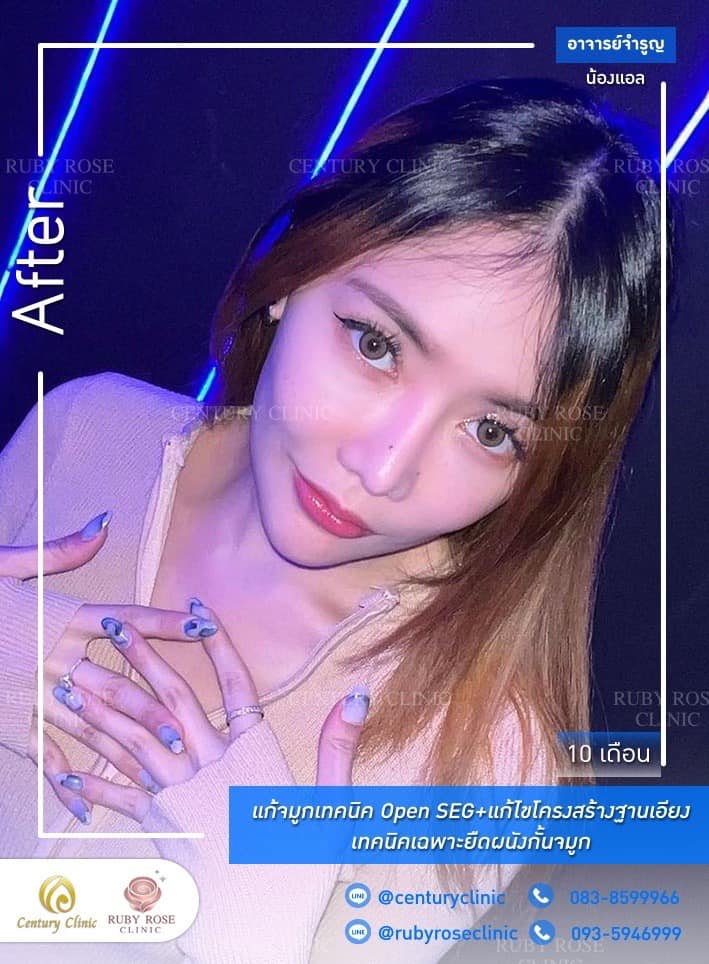 Century-รีวิว-แก้จมูก #508