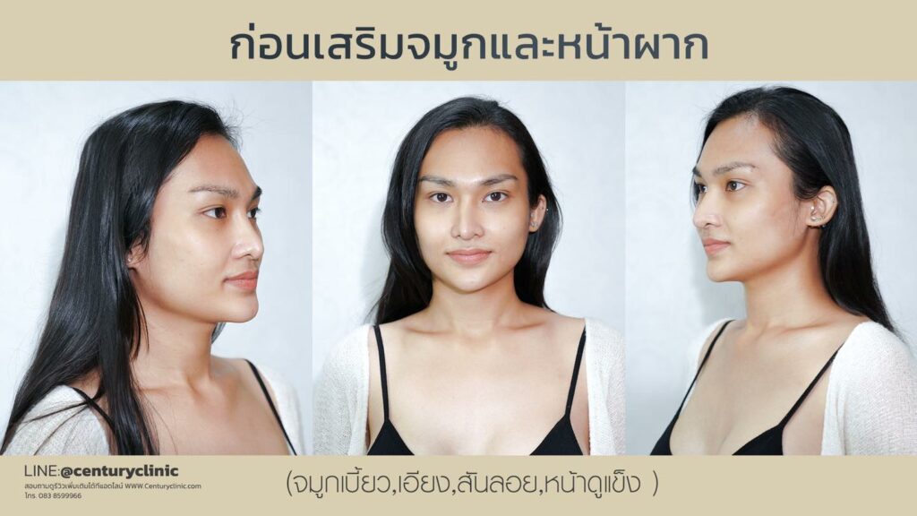 Century-รีวิว-แก้จมูก-เสริมหน้าผาก 1#438