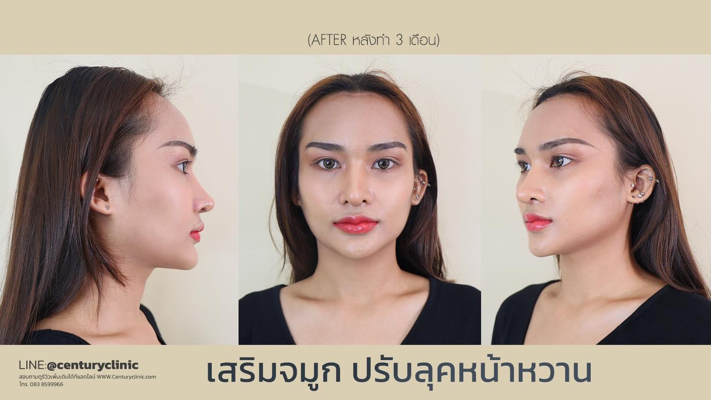Century-รีวิว-แก้จมูก-เสริมหน้าผาก 2#438