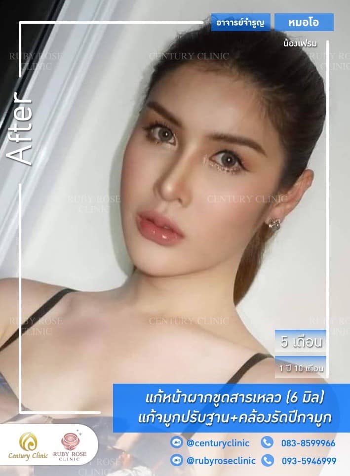 รีวิว แก้จมูก #432 , Century Clinic Thailand Century-รีวิว-แก้จมูก-แก้หน้าผาก 1#432
