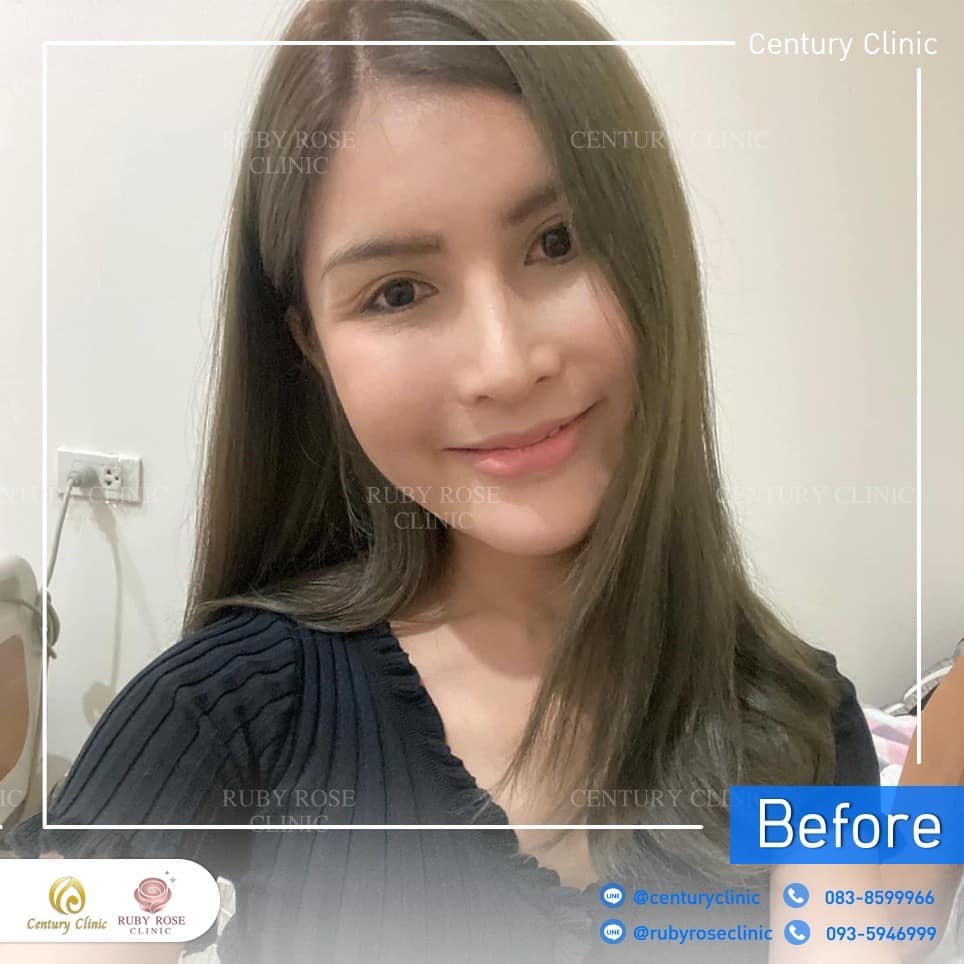 รีวิว แก้จมูก #432 , Century Clinic Thailand Century-รีวิว-แก้จมูก-แก้หน้าผาก 2#432