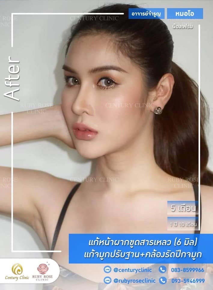 Century-รีวิว-แก้จมูก-แก้หน้าผาก #432