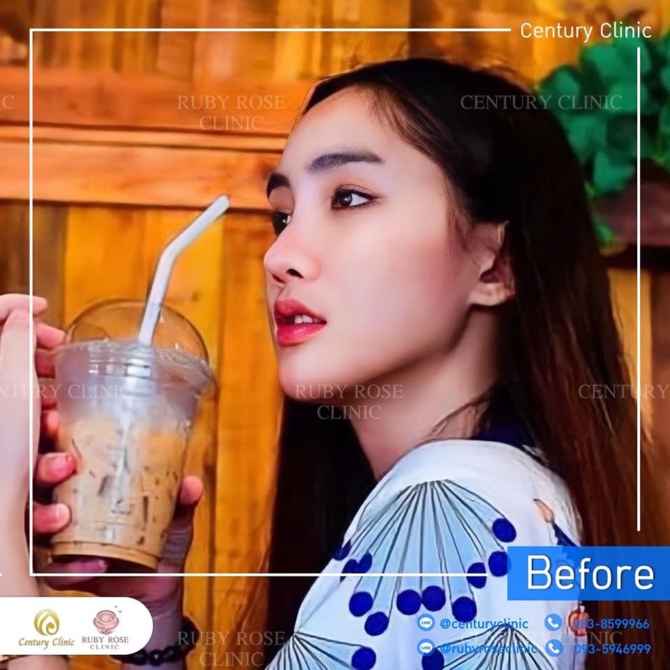 รีวิว แก้หน้าผากขูดสารเหลว1#21