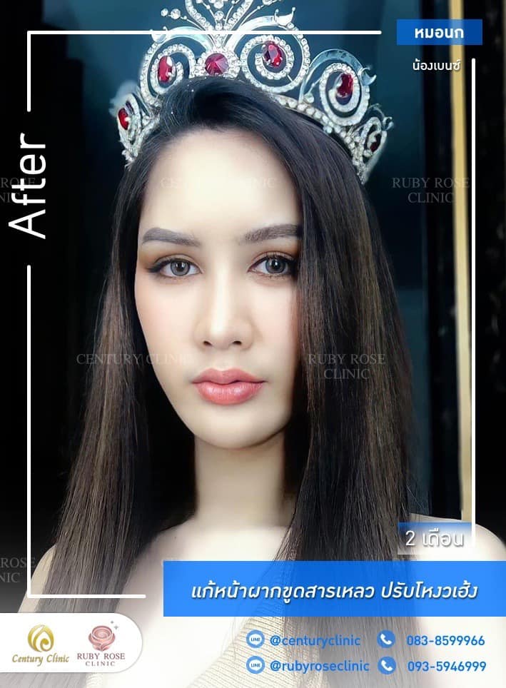 รีวิว แก้หน้าผากขูดสารเหลว#21