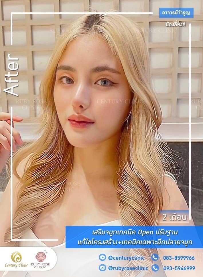 Century-รีวิว-เสริมจมูก 1#518