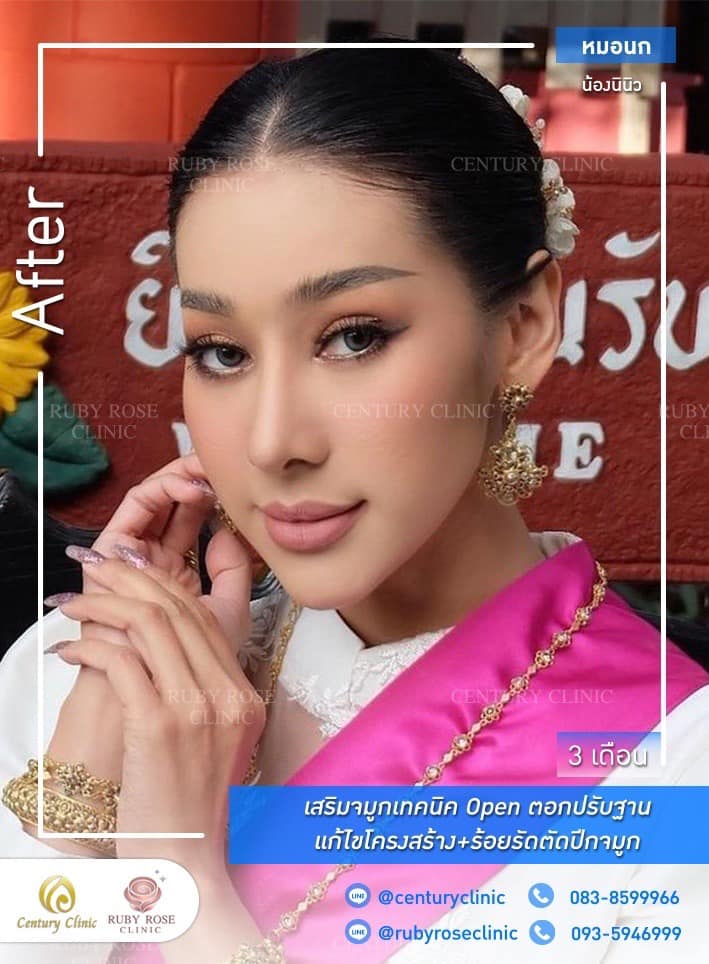 รีวิว เสริมจมูก #525 , Century Clinic Thailand Century-รีวิว-เสริมจมูก 1#525