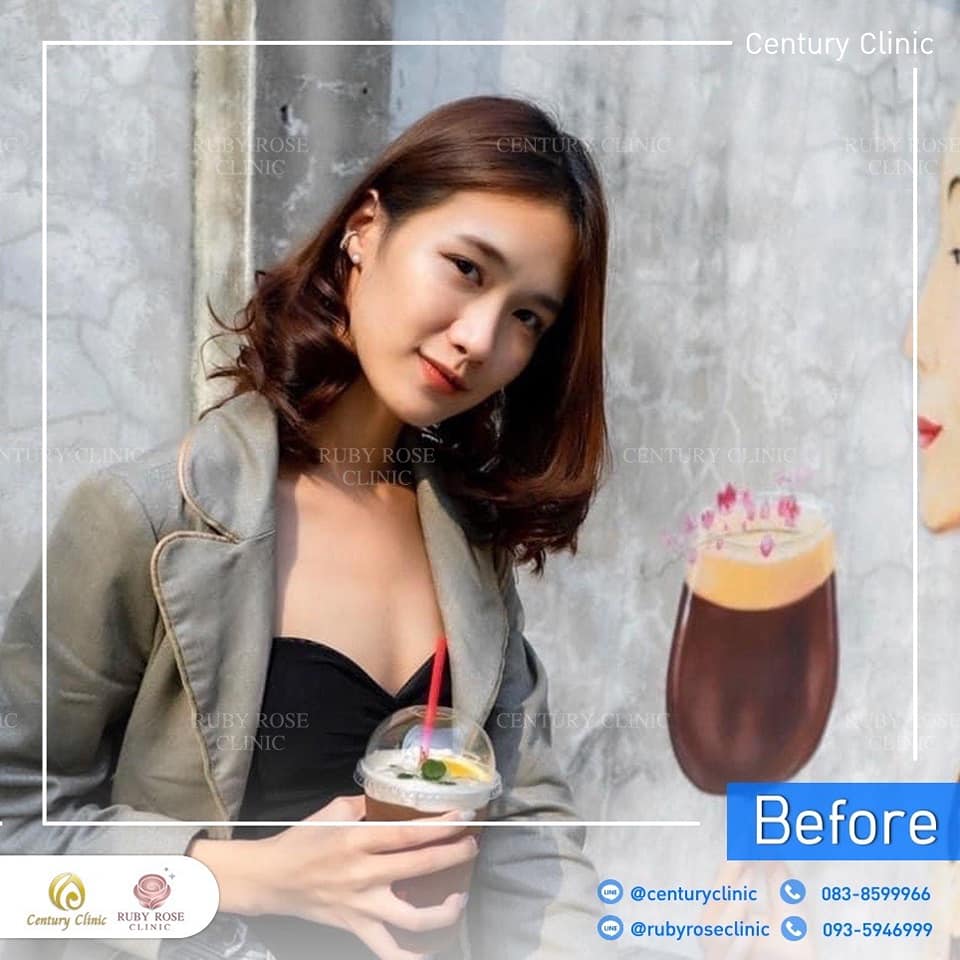 Century-รีวิว-เสริมจมูก 1#527