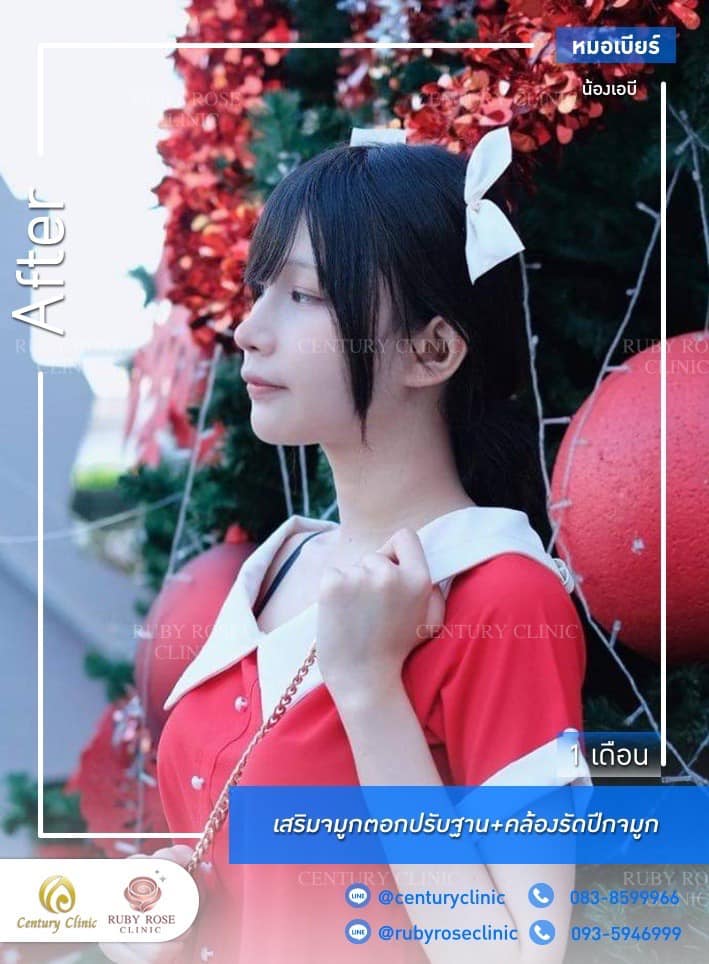 Century-รีวิว-เสริมจมูก 1#537