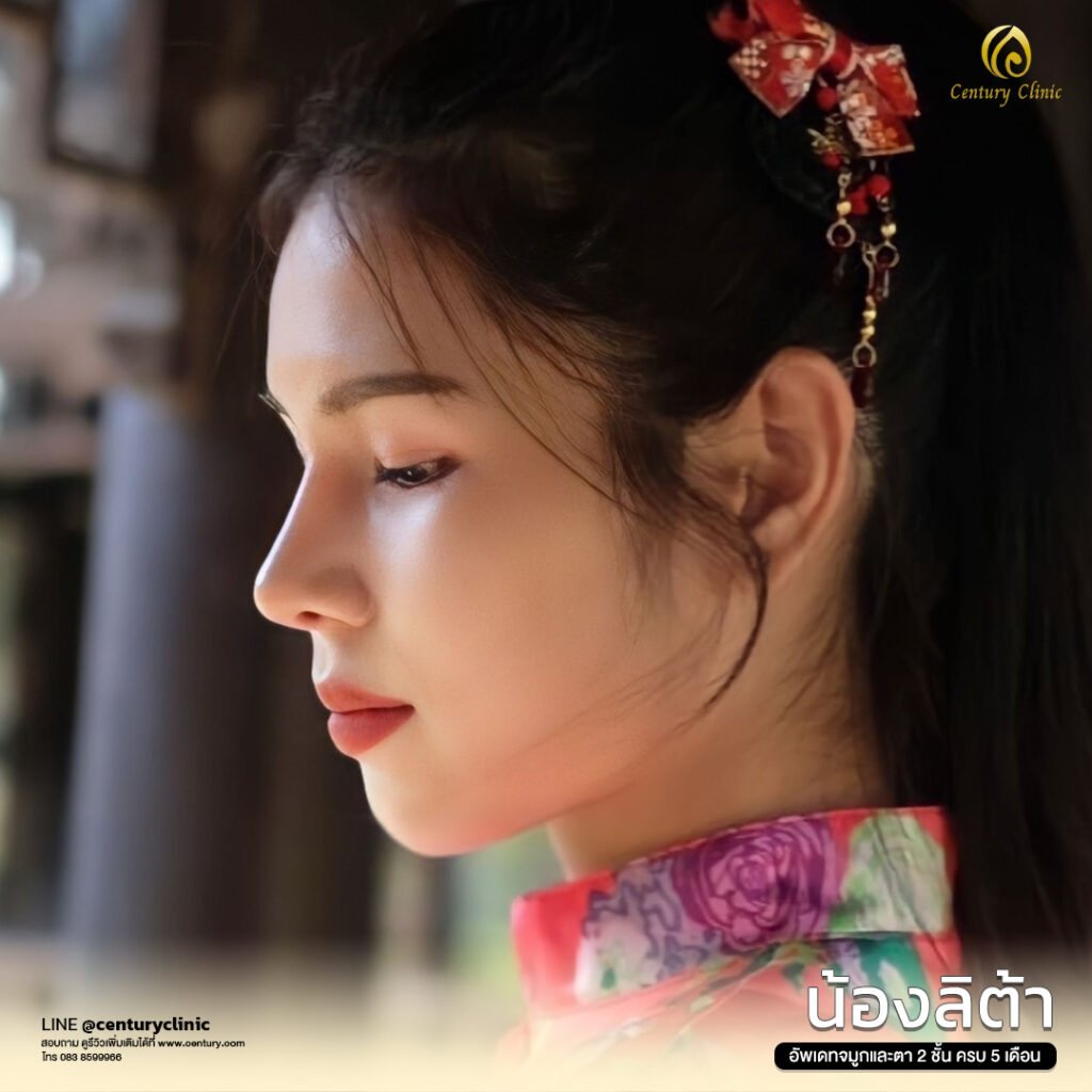 Century-รีวิว-เสริมจมูก 1#569