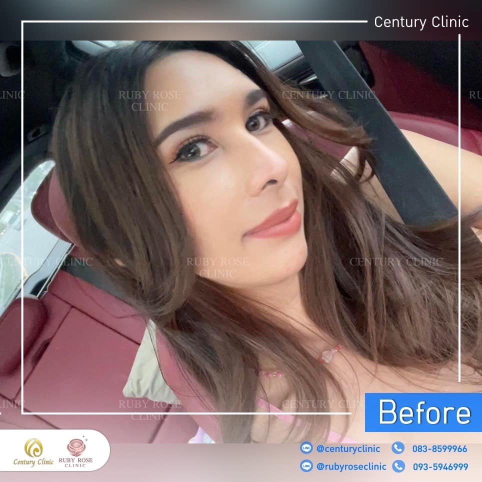 รีวิว เสริมจมูก #514 , Century Clinic Thailand Century-รีวิว-เสริมจมูก 2#514