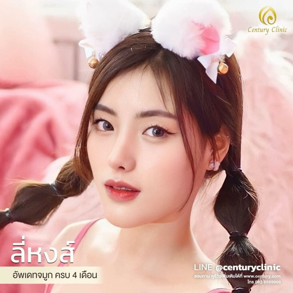 รีวิว เสริมจมูก #562 , Century Clinic Thailand Century-รีวิว-เสริมจมูก 2#562