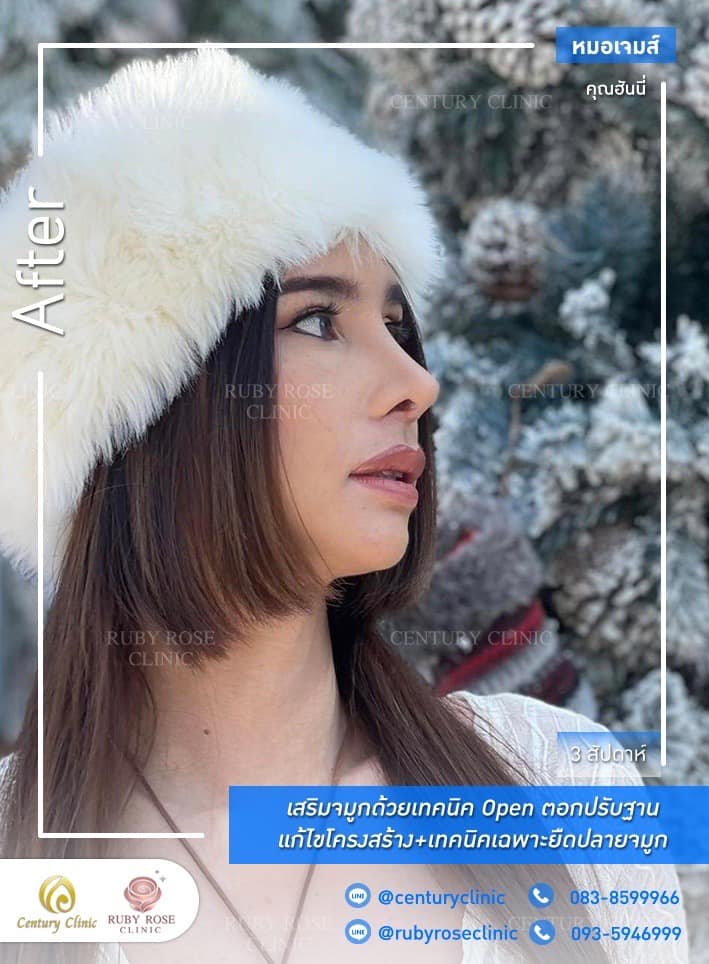 รีวิว เสริมจมูก #514 , Century Clinic Thailand Century-รีวิว-เสริมจมูก #514