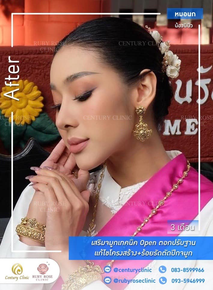 รีวิว เสริมจมูก #525 , Century Clinic Thailand Century-รีวิว-เสริมจมูก #525