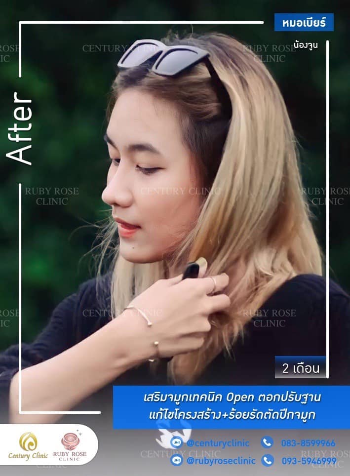 Century-รีวิว-เสริมจมูก #527