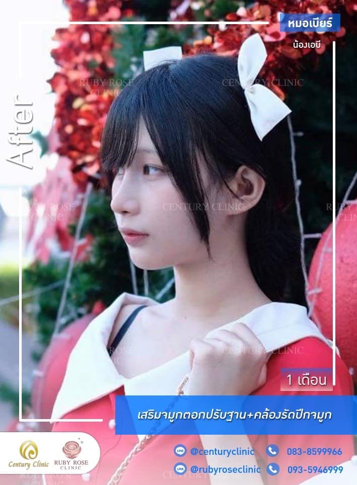 Century-รีวิว-เสริมจมูก #537