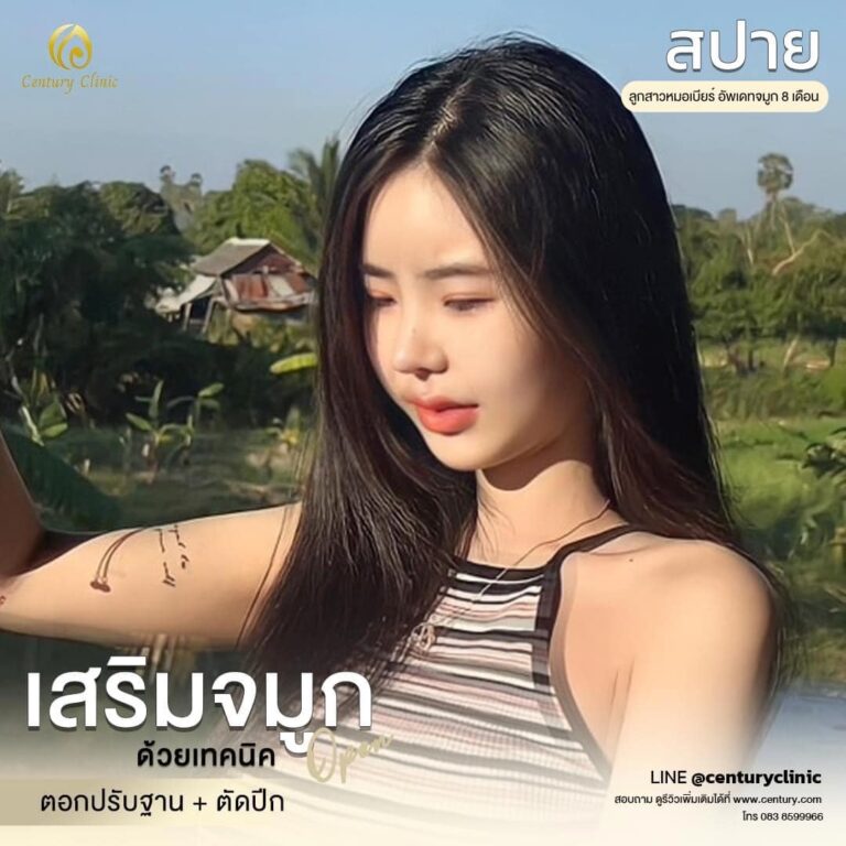 Century-รีวิว-เสริมจมูก #558