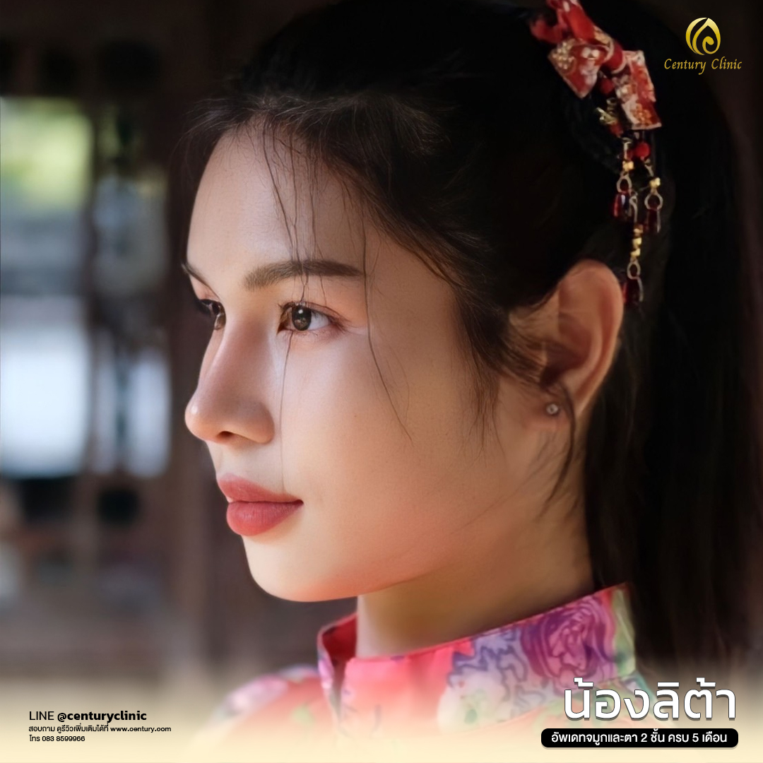 Century-รีวิว-เสริมจมูก #569