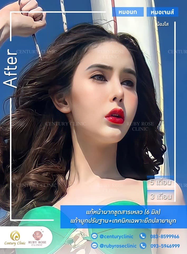 Century-รีวิว-แก้จมูก 1#510